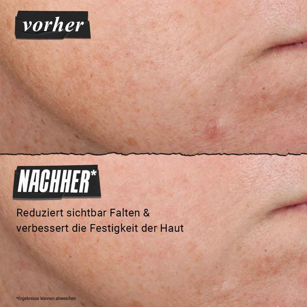 Vorher-Nachher-Foto – Kiehl's Retinol Skin-Renewing Daily Micro-Dose Serum hilft dabei, Hautton & -textur zu verbessern