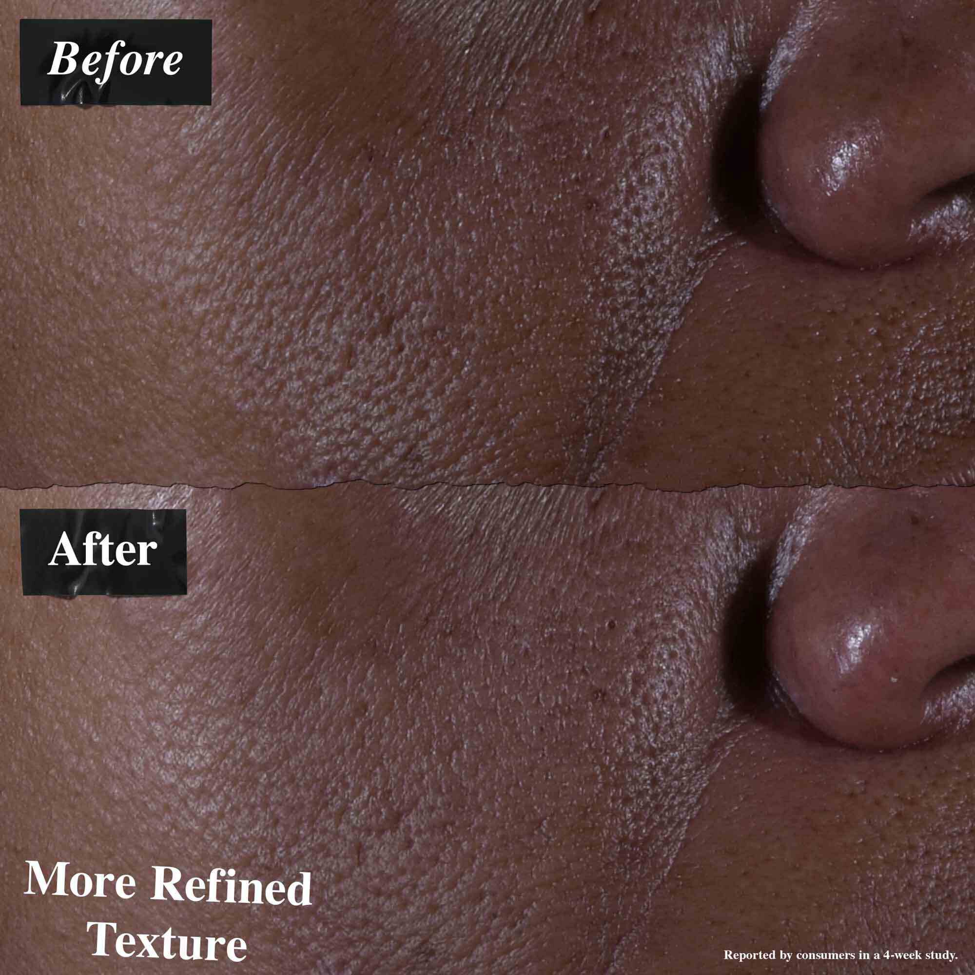 Ein Vorher-Nachher-Vergleich, der mit Ultra Pure 9.8% Glycolic Acid Serum behandelte Haut zeigt. Das „Vorher“-Bild zeigt eine unebene Textur, wahrend das „Nachher“-Bild eine verfeinerte Textur zeigt.