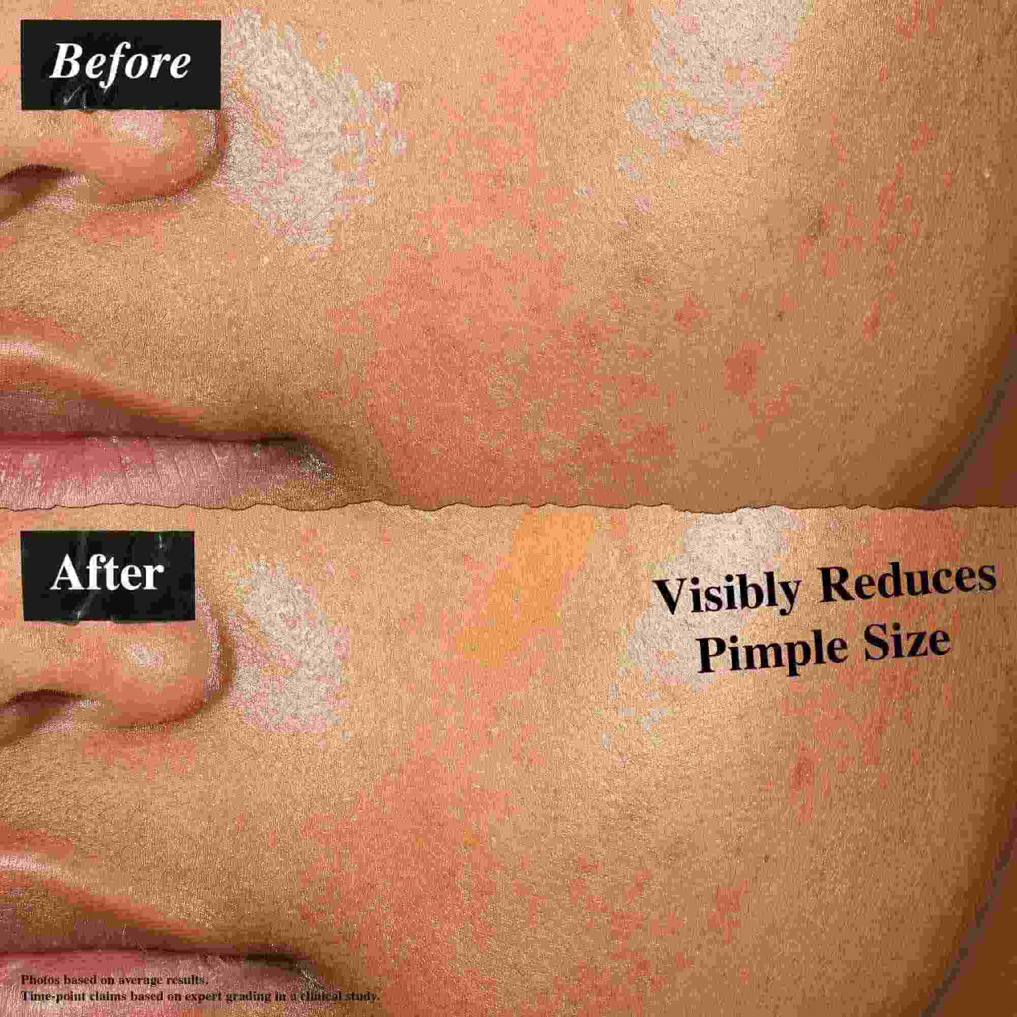 Ein Vorher-Nachher-Vergleich, der mit Truly-Targeted Blemish-Clearing Solution behandelte Haut zeigt. Das "Vorher"-Bild zeigt sichtbare Pickel, wahrend das "Nachher"-Bild eine reduzierte Pickelgroße zeigt.