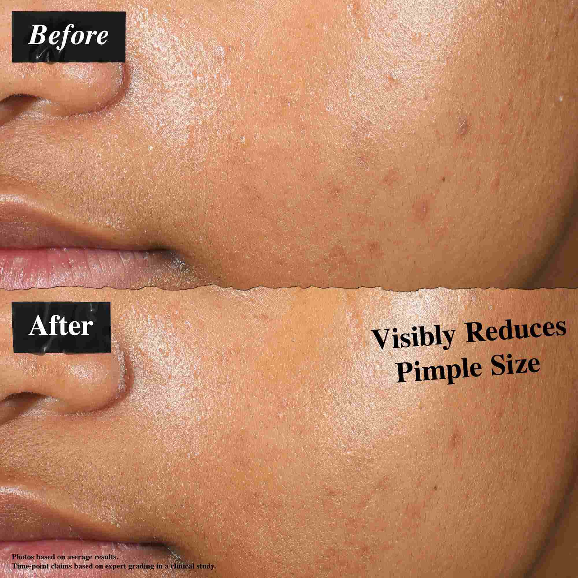 Ein Vorher-Nachher-Vergleich, der mit Truly-Targeted Blemish-Clearing Solution behandelte Haut zeigt. Das "Vorher"-Bild zeigt sichtbare Pickel, wahrend das "Nachher"-Bild eine reduzierte Pickelgroße zeigt.