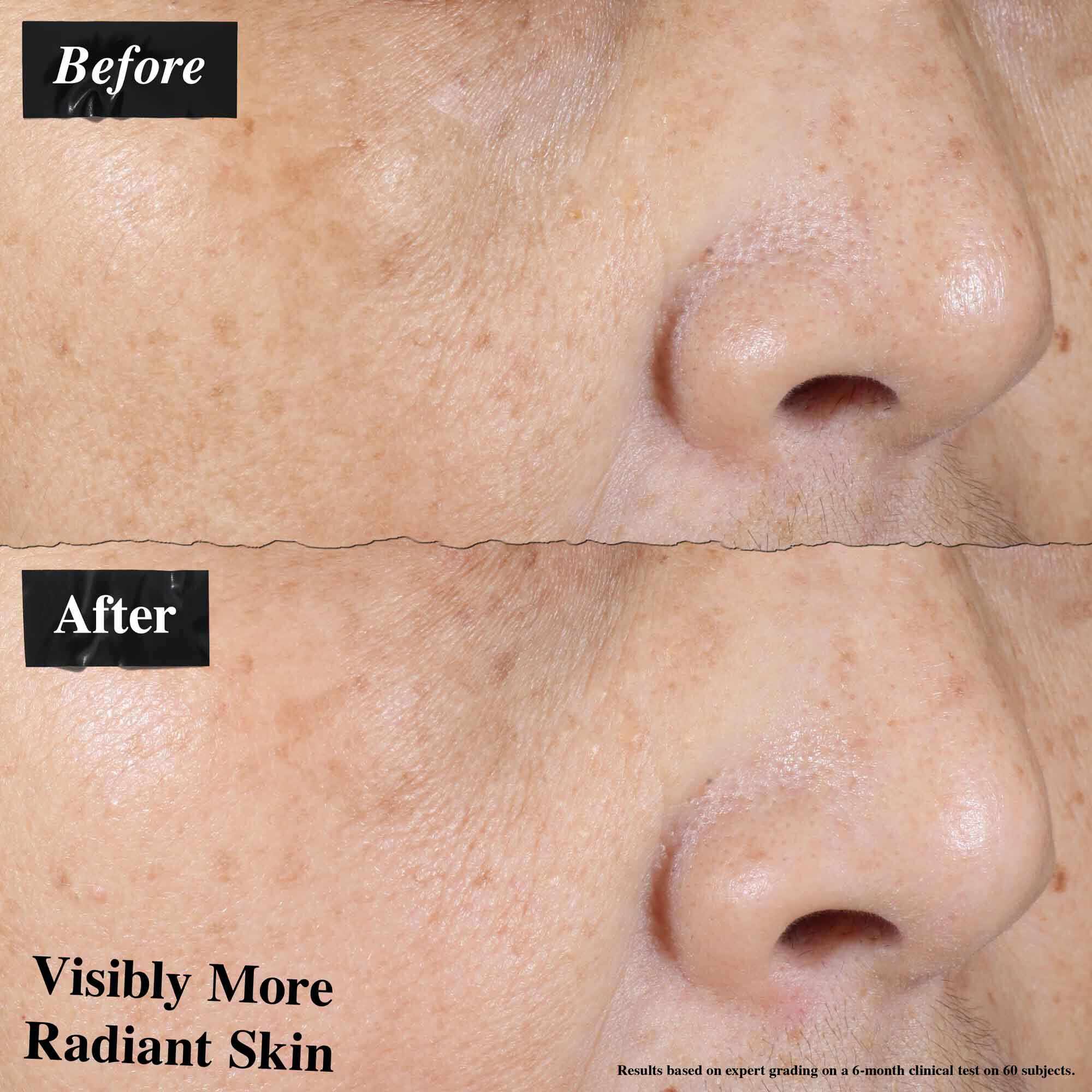 Ein Vorher-Nachher-Vergleich, der sichtbar reduzierte Hautrotungen nach der Anwendung von Ultra-Light Daily UV Defense zeigt.