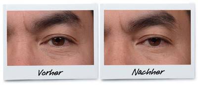  Augenringe beim Mann: Vorher-Nachher Bild