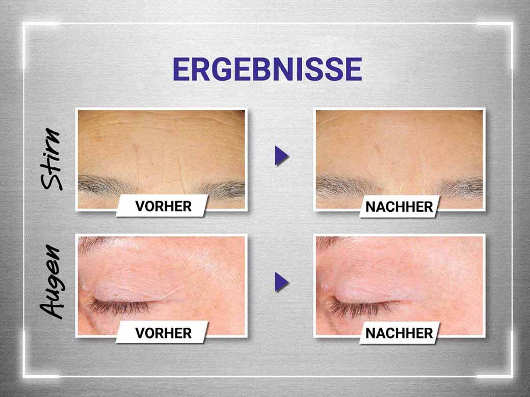 Vorher-Nachher-Vergleich von Stirn und Augen nach Auftragen des Kiehl‘s Retinol Serums