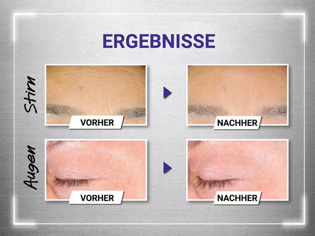 Vorher-Nachher-Vergleich von Stirn und Augen nach Auftragen des Kiehl‘s Retinol Serums