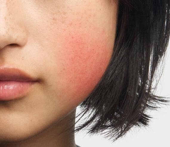 Wange einer Frau mit Rotung und Hautrotungen, wie sie bei Rosazea typisch sind
