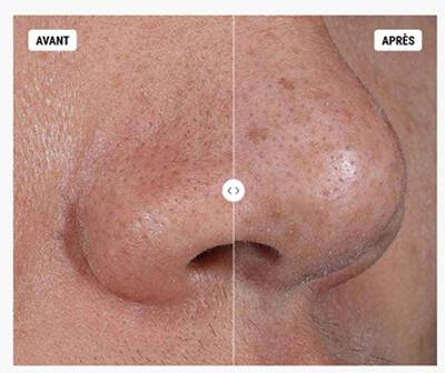 Wirkung der Rare Earth Deep Pore Cleansing Mask: Vorher-Nachher-Ergebnis