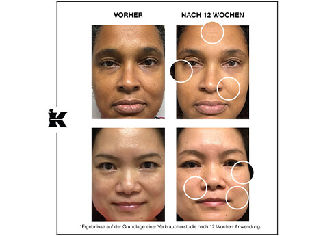 Retinol Skin-Renewing Daily Micro-Dose Serum Vorher-Nachher